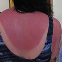 a sunburned person